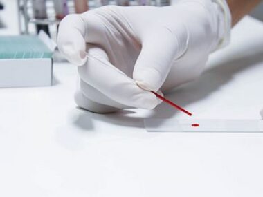 blood spots and AADC diagnosis