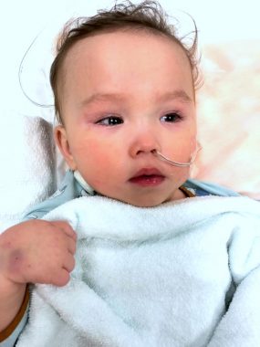 feeding issues | AADC News | Rylae-Ann has a feeding tube inserted into her nose after being admitted to the hospital.