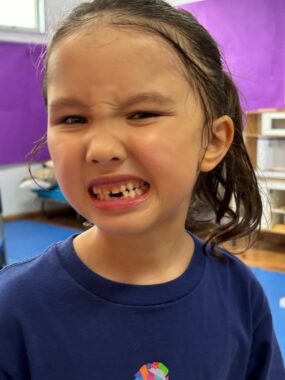 A 6-year-old girl grimaces and forces a wide grin to show off the space where two missing teeth had been in her bottom row She's in some type of play or therapy room with purple walls. The photo is a close-up.